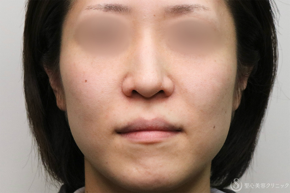 【30代女性・法令線を目立ちにくく】プレミアムPRP皮膚再生療法（7ヶ月後） After 名古屋・法令線・名古屋駅・アンチエイジング・若返り・注射で若返り