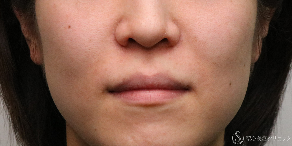 【30代女性・法令線を目立ちにくく】プレミアムPRP皮膚再生療法（7ヶ月後） After 名古屋・法令線・名古屋駅・アンチエイジング・若返り・注射で若返り