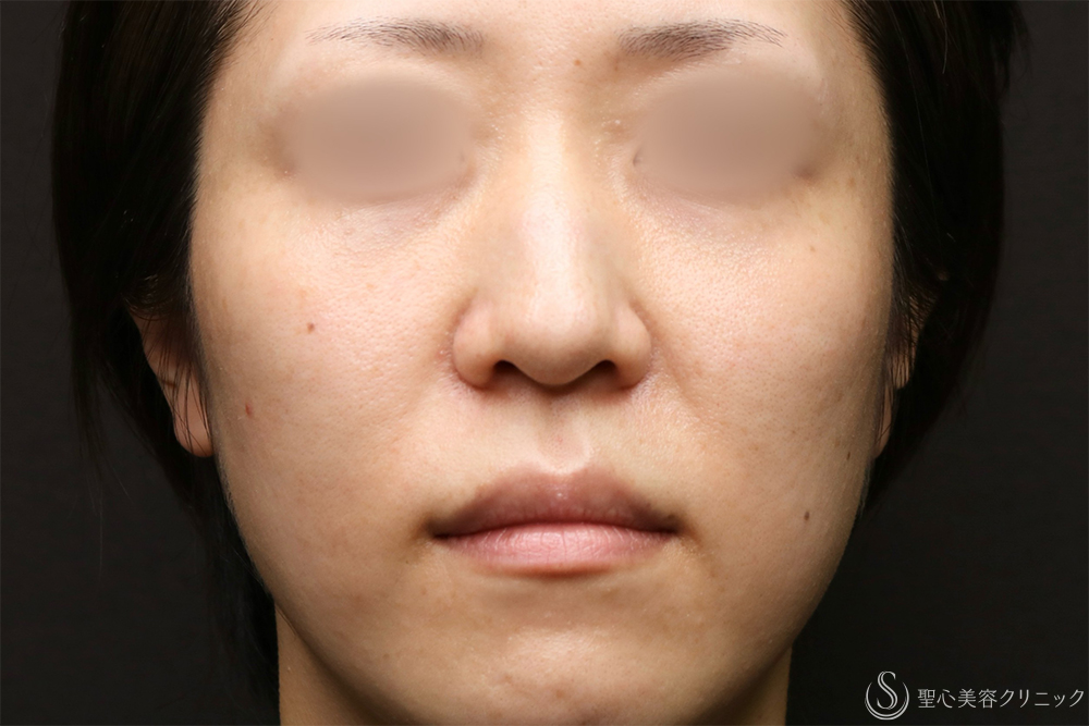 【30代女性・法令線を目立ちにくく】プレミアムPRP皮膚再生療法（7ヶ月後） Before 名古屋・法令線・名古屋駅・アンチエイジング・若返り・注射で若返り