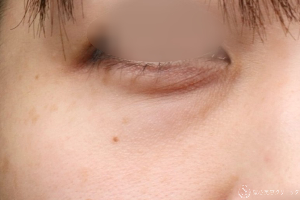【30代女性・クマを改善】目の下の脂肪取り（経結膜下脱脂法）+プレミアムPRP皮膚再生療法（目の下）（1年2ヶ月後） Before 名古屋　クマ取り　目の下　たるみ取り　名駅　名古屋駅　愛知　クマ治療
