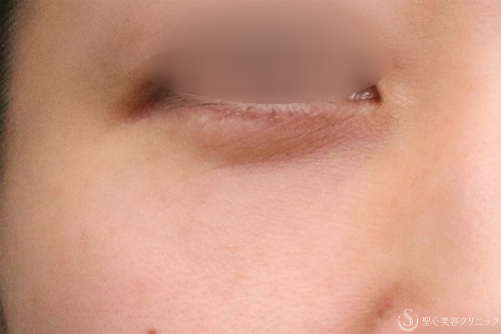 【30代女性・クマを改善】目の下の脂肪取り（経結膜下脱脂法）+プレミアムPRP皮膚再生療法（目の下）（1年2ヶ月後） After 名古屋　クマ取り　目の下　たるみ取り　名駅　名古屋駅　愛知　クマ治療