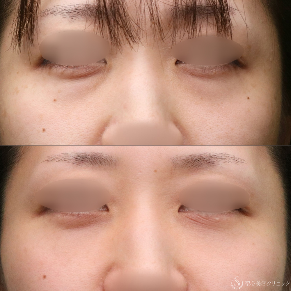 【30代女性・クマを改善】目の下の脂肪取り（経結膜下脱脂法）+プレミアムPRP皮膚再生療法（目の下）（1年2ヶ月後） After 名古屋　クマ取り　目の下　たるみ取り　名駅　名古屋駅　愛知　クマ治療