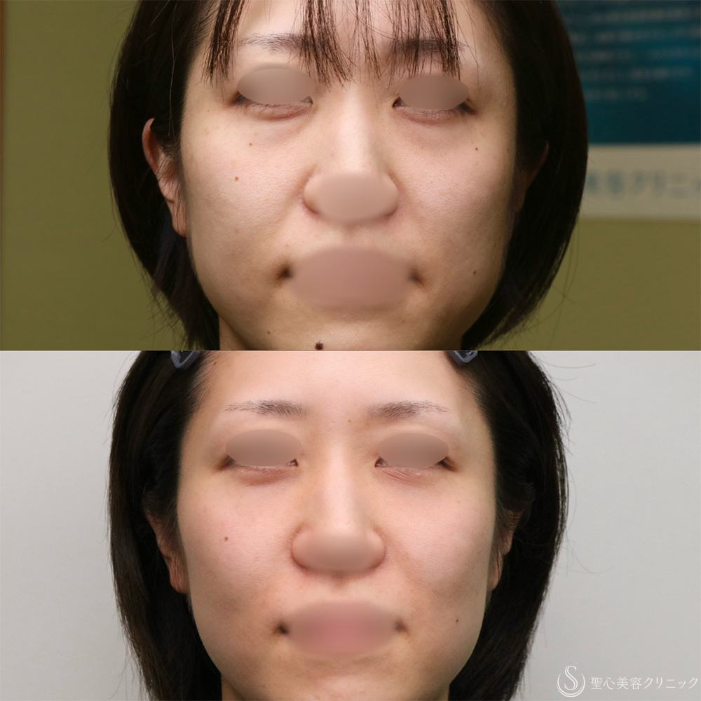 【30代女性・クマを改善】目の下の脂肪取り（経結膜下脱脂法）+プレミアムPRP皮膚再生療法（目の下）（1年2ヶ月後） After 名古屋　クマ取り　目の下　たるみ取り　名駅　名古屋駅　愛知　クマ治療