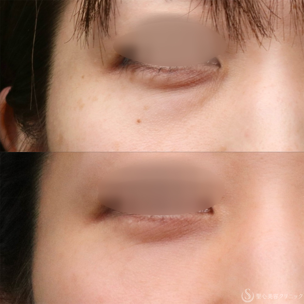 【30代女性・クマを改善】目の下の脂肪取り（経結膜下脱脂法）+プレミアムPRP皮膚再生療法（目の下）（1年2ヶ月後） After 名古屋　クマ取り　目の下　たるみ取り　名駅　名古屋駅　愛知　クマ治療