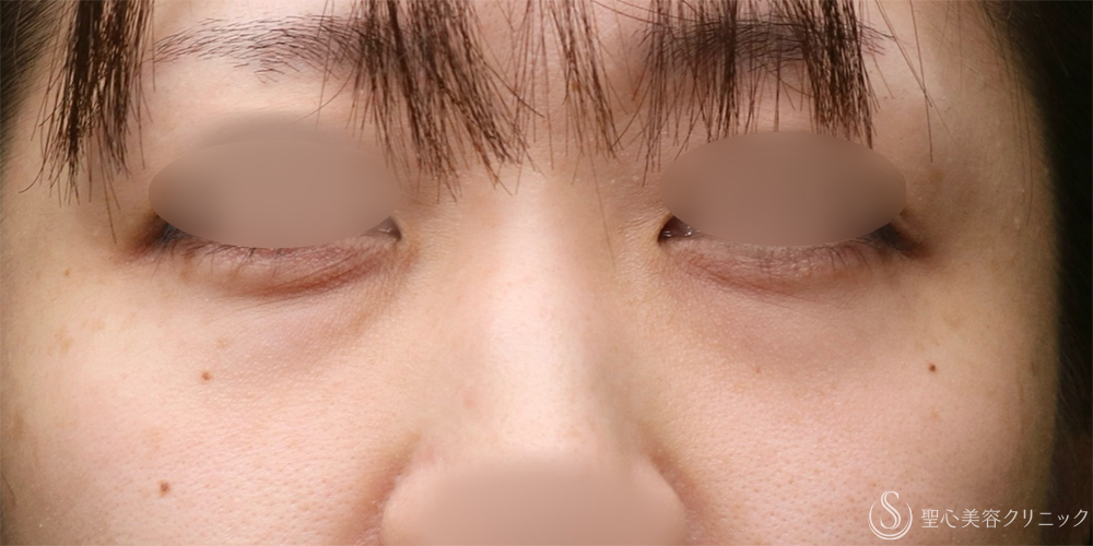 【30代女性・クマを改善】目の下の脂肪取り（経結膜下脱脂法）+プレミアムPRP皮膚再生療法（目の下）（1年2ヶ月後） Before 名古屋　クマ取り　目の下　たるみ取り　名駅　名古屋駅　愛知　クマ治療