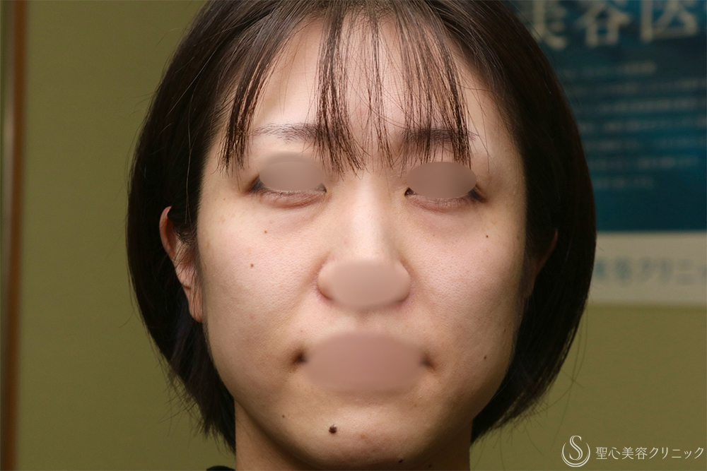 【30代女性・クマを改善】目の下の脂肪取り（経結膜下脱脂法）+プレミアムPRP皮膚再生療法（目の下）（1年2ヶ月後） Before 名古屋　クマ取り　目の下　たるみ取り　名駅　名古屋駅　愛知　クマ治療