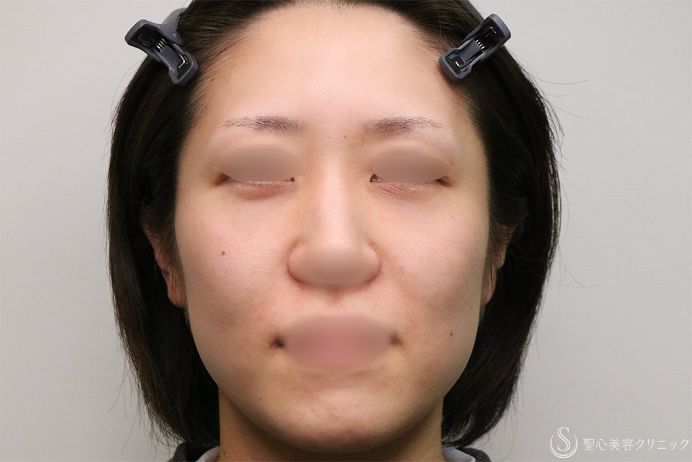 【30代女性・クマを改善】目の下の脂肪取り（経結膜下脱脂法）+プレミアムPRP皮膚再生療法（目の下）（1年2ヶ月後） After 名古屋　クマ取り　目の下　たるみ取り　名駅　名古屋駅　愛知　クマ治療