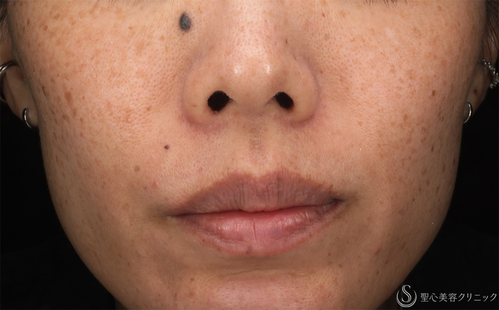 【40代女性・そばかすを一掃】PICOルビーフラクショナル（1ヶ月後） Before 