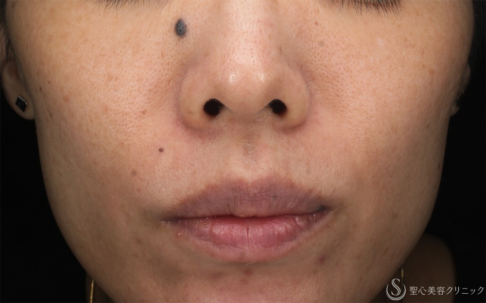 【40代女性・そばかすを一掃】PICOルビーフラクショナル（1ヶ月後） After 