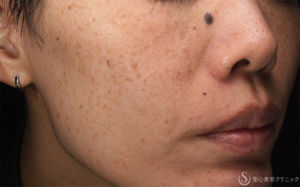 【40代女性・そばかすを一掃】PICOルビーフラクショナル（1ヶ月後） Before 