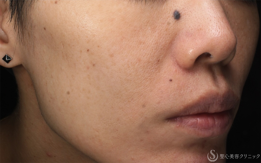 【40代女性・そばかすを一掃】PICOルビーフラクショナル（1ヶ月後） After 