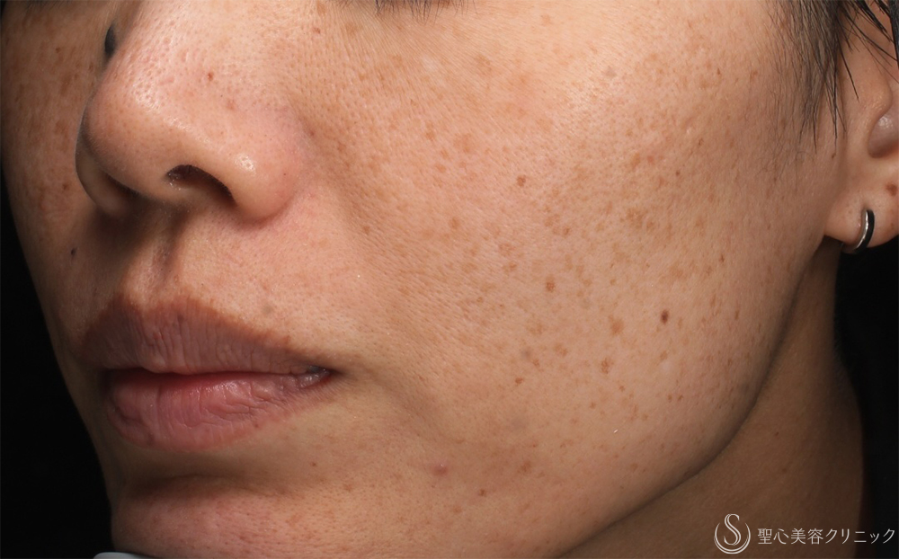 【40代女性・そばかすを一掃】PICOルビーフラクショナル（1ヶ月後） Before 