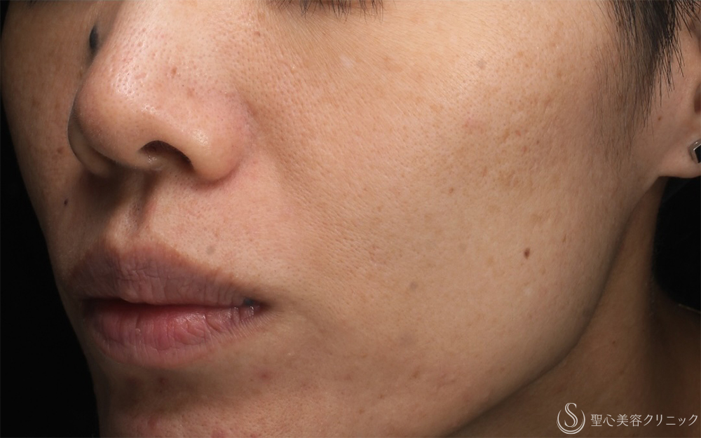 【40代女性・そばかすを一掃】PICOルビーフラクショナル（1ヶ月後） After 