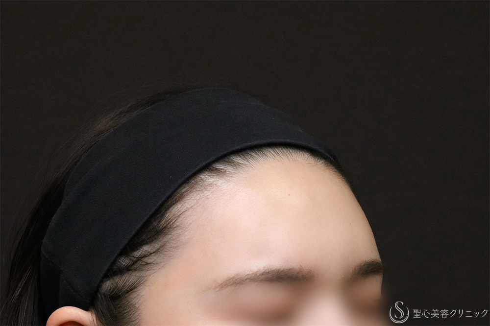 【30代女性・額をきれいに丸く】プレミアムPRP皮膚再生療法（8ヶ月後） After 額脂肪注入　名古屋　名古屋駅　名駅　おでこ　額整形　ヒアルロン酸注入