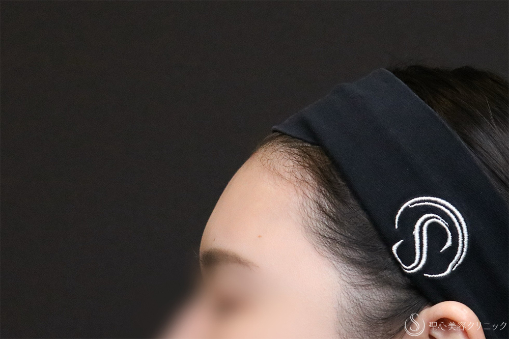 【30代女性・額をきれいに丸く】プレミアムPRP皮膚再生療法（8ヶ月後） After 額脂肪注入　名古屋　名古屋駅　名駅　おでこ　額整形　ヒアルロン酸注入