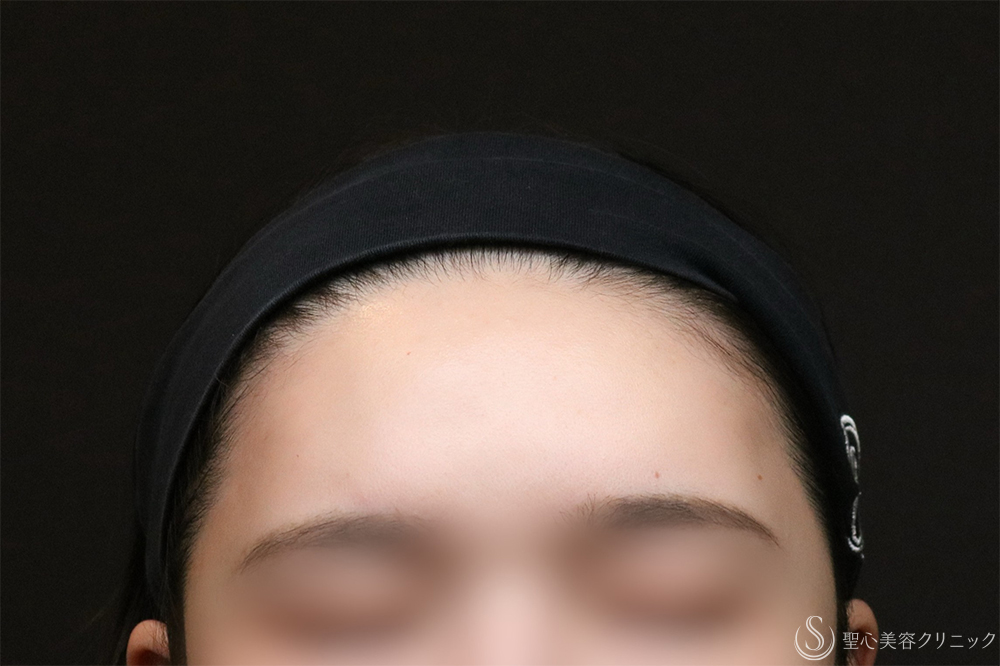 【30代女性・額をきれいに丸く】プレミアムPRP皮膚再生療法（8ヶ月後） After 額脂肪注入　名古屋　名古屋駅　名駅　おでこ　額整形　ヒアルロン酸注入