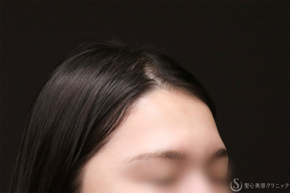 【30代女性・額をきれいに丸く】プレミアムPRP皮膚再生療法（8ヶ月後） Before 額脂肪注入　名古屋　名古屋駅　名駅　おでこ　額整形　ヒアルロン酸注入