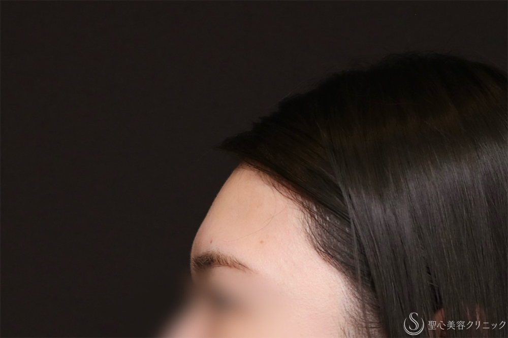 【30代女性・額をきれいに丸く】プレミアムPRP皮膚再生療法（8ヶ月後） Before 額脂肪注入　名古屋　名古屋駅　名駅　おでこ　額整形　ヒアルロン酸注入