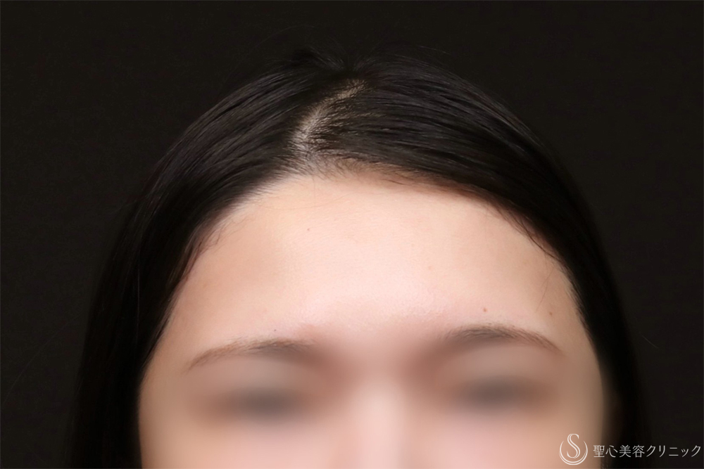 【30代女性・額をきれいに丸く】プレミアムPRP皮膚再生療法（8ヶ月後） Before 額脂肪注入　名古屋　名古屋駅　名駅　おでこ　額整形　ヒアルロン酸注入