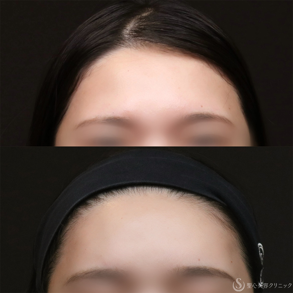 【30代女性・額をきれいに丸く】プレミアムPRP皮膚再生療法（8ヶ月後） After 額脂肪注入　名古屋　名古屋駅　名駅　おでこ　額整形　ヒアルロン酸注入
