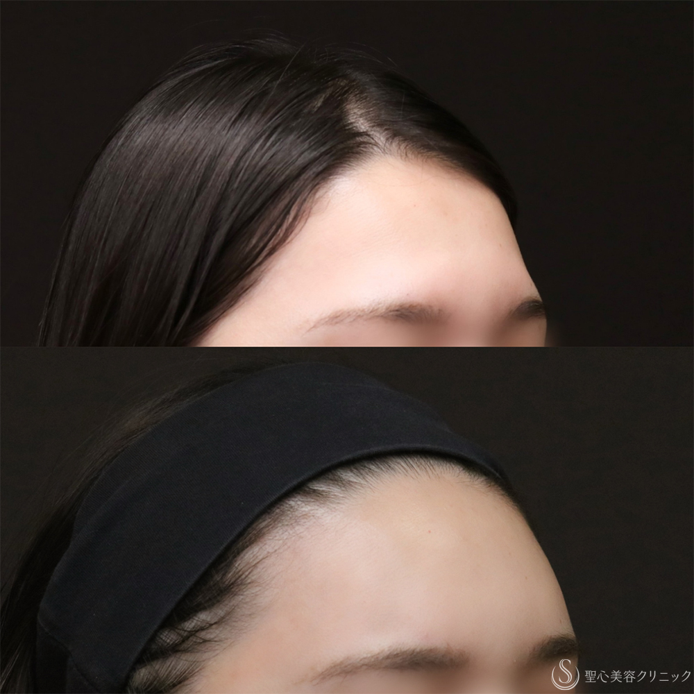 【30代女性・額をきれいに丸く】プレミアムPRP皮膚再生療法（8ヶ月後） After 額脂肪注入　名古屋　名古屋駅　名駅　おでこ　額整形　ヒアルロン酸注入