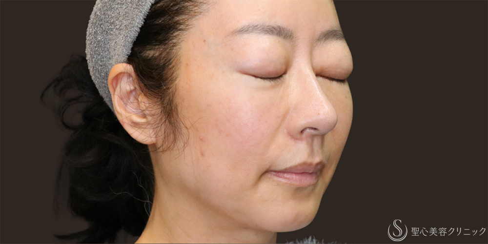 【40代女性・フェイスラインのリフトアップ】フィオラスレッドFL（4本）＋アンカーマックス（8本）（1ヶ月後） Before 名古屋　リフトアップ　糸　フェイスリフト　小顔