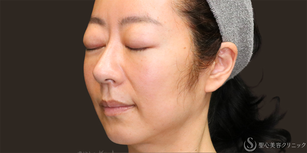 【40代女性・フェイスラインのリフトアップ】フィオラスレッドFL（4本）＋アンカーマックス（8本）（1ヶ月後） Before 名古屋　リフトアップ　糸　フェイスリフト　小顔