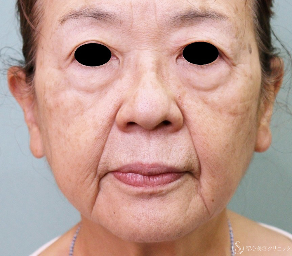 【80代女性・目の下、ほうれい線、マリオネットライン】プレミアムPRP皮膚再生療法（5年後） Before 