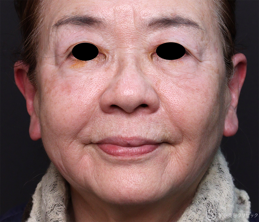 【80代女性・目の下、ほうれい線、マリオネットライン】プレミアムPRP皮膚再生療法（5年後） After 