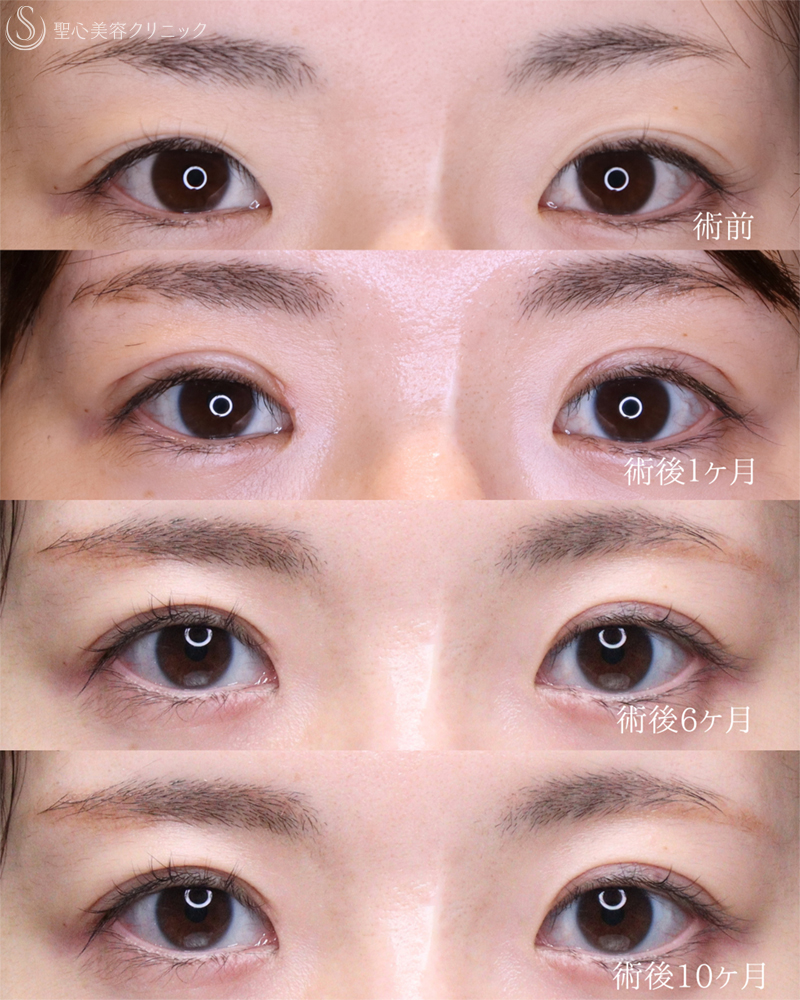 【30代女性・自然さを保ち緩みのない二重へ】 二重術（切開法）部分切開/全切開＋右目上切開（10ヶ月後） After 