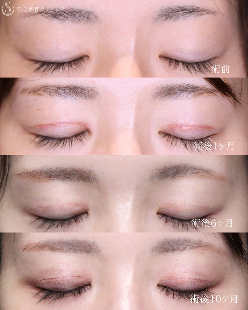 【30代女性・自然さを保ち緩みのない二重へ】 二重術（切開法）部分切開/全切開＋右目上切開（10ヶ月後） After 