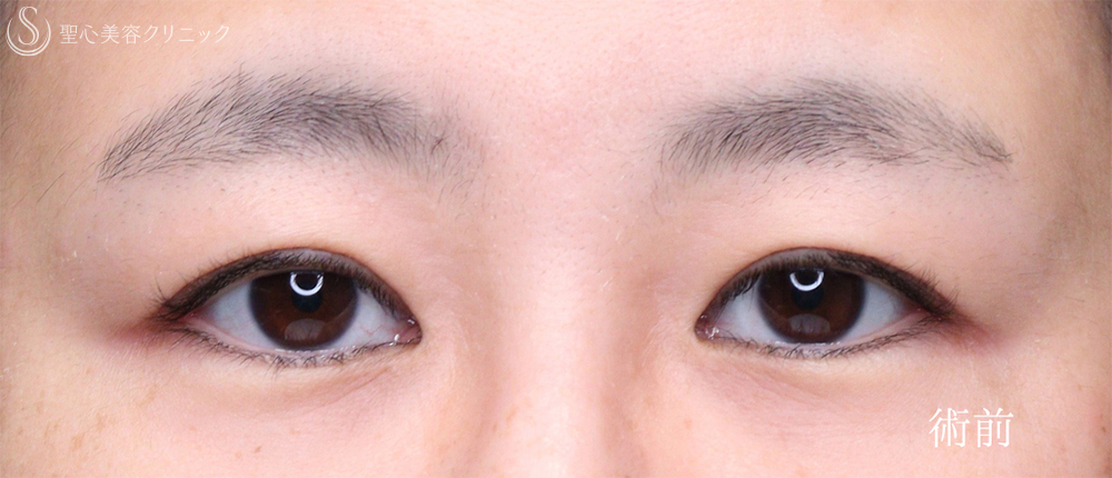 【40代女性・目元のナチュラルアップデート】眼瞼下垂手術（2ヶ月） Before 