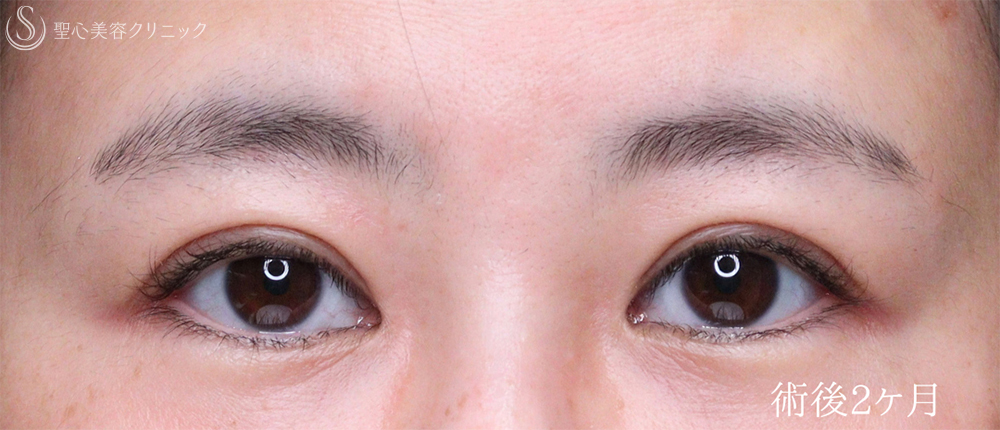 【40代女性・目元のナチュラルアップデート】眼瞼下垂手術（2ヶ月） After 