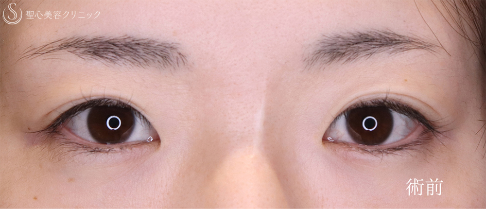 【30代女性・自然さを保ち緩みのない二重へ】 二重術（切開法）部分切開/全切開＋右目上切開（10ヶ月後） Before 