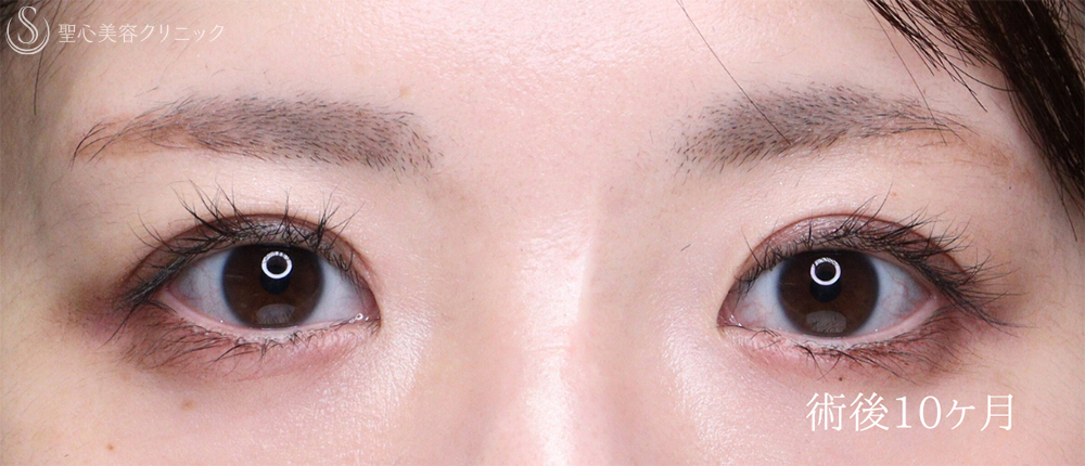 【30代女性・自然さを保ち緩みのない二重へ】 二重術（切開法）部分切開/全切開＋右目上切開（10ヶ月後） After 
