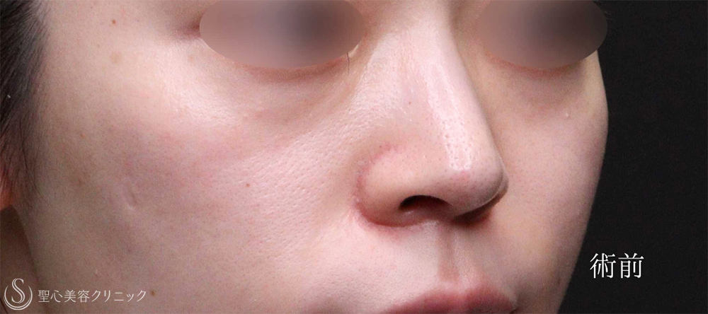 【20代女性・ほうれい線と目の下を自然にボリュームアップ】 プレミアムPRP皮膚再生療法（6ヶ月後） Before 