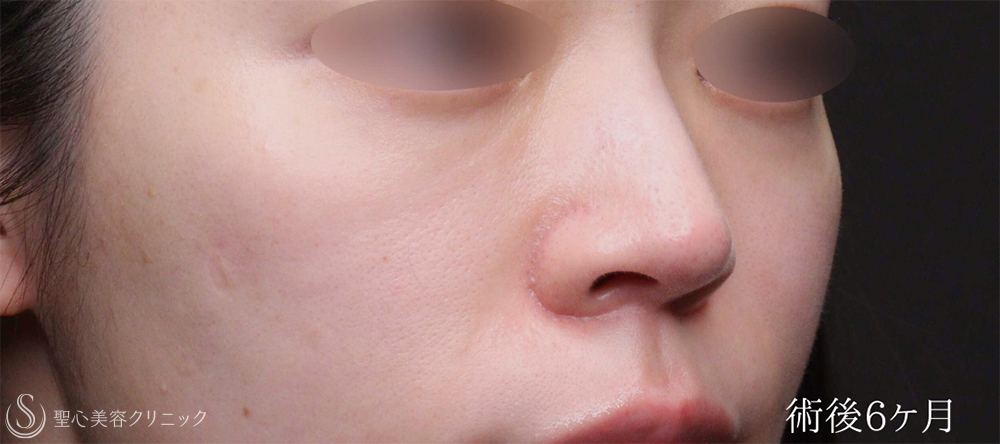 【20代女性・ほうれい線と目の下を自然にボリュームアップ】 プレミアムPRP皮膚再生療法（6ヶ月後） After 