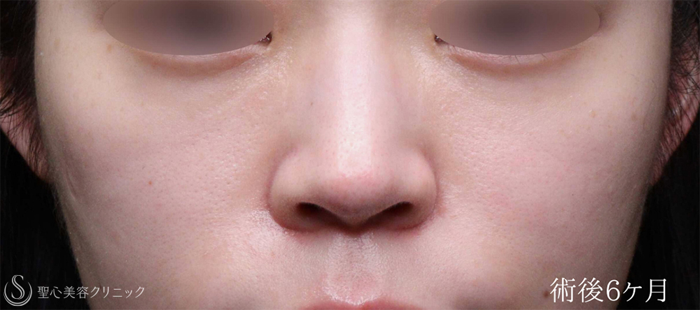 【20代女性・ほうれい線と目の下を自然にボリュームアップ】 プレミアムPRP皮膚再生療法（6ヶ月後） After 