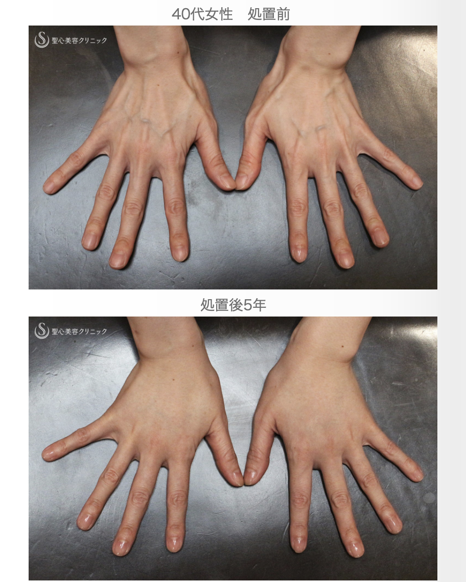 【40代女性・手の甲の若返り長期経過】プレミアムPRP皮膚再生療法（5年後） After 
