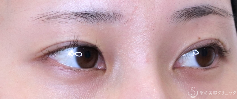 【20代女性・目頭側の重さ解消】目上切開（1ヶ月後） Before 