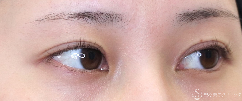 【20代女性・目頭側の重さ解消】目上切開（1ヶ月後） After 