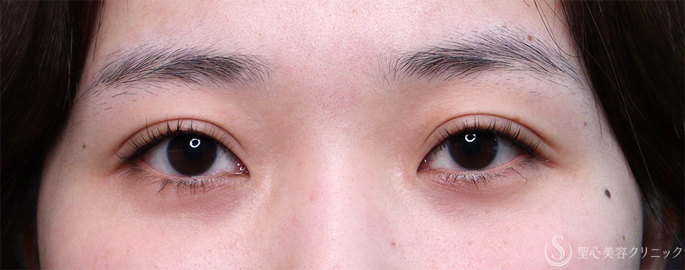 【20代女性・眠そうな目元】眼瞼下垂埋没法（直後・2ヶ月後） Before 