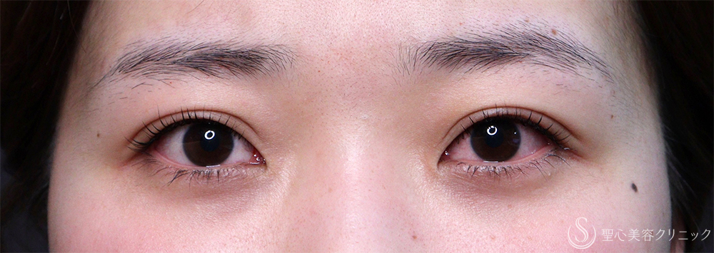 【20代女性・眠そうな目元】眼瞼下垂埋没法（直後・2ヶ月後） After 