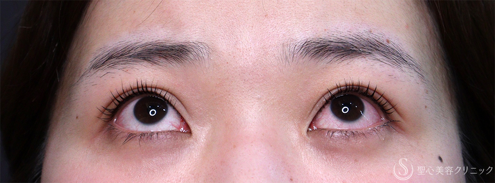 【20代女性・眠そうな目元】眼瞼下垂埋没法（直後・2ヶ月後） After 