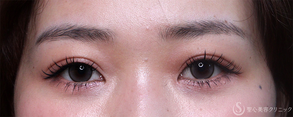 【20代女性・眠そうな目元】眼瞼下垂埋没法（直後・2ヶ月後） After 