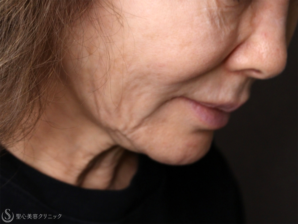 【70代女性・機械の引き締めでも難しいたるみにも有効】PDRNモノスレッド（3ヶ月後） Before 