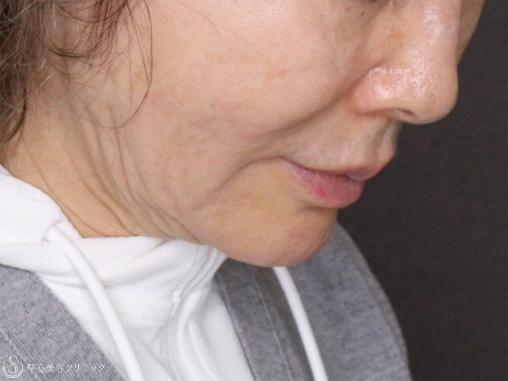 【70代女性・機械の引き締めでも難しいたるみにも有効】PDRNモノスレッド（3ヶ月後） After 