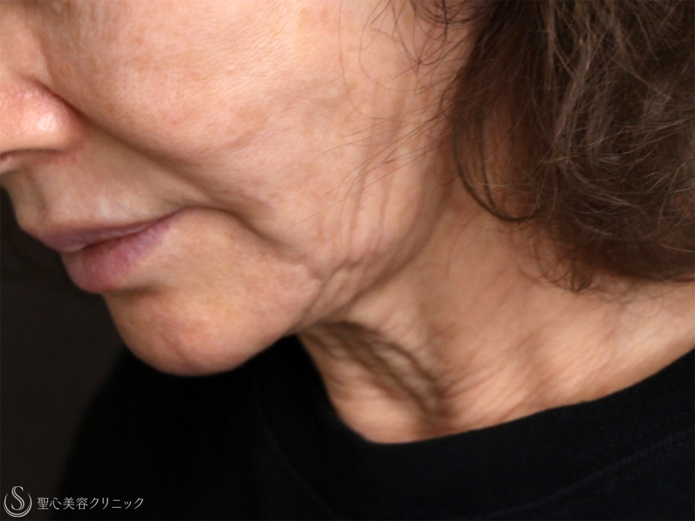 【70代女性・機械の引き締めでも難しいたるみにも有効】PDRNモノスレッド（3ヶ月後） Before 