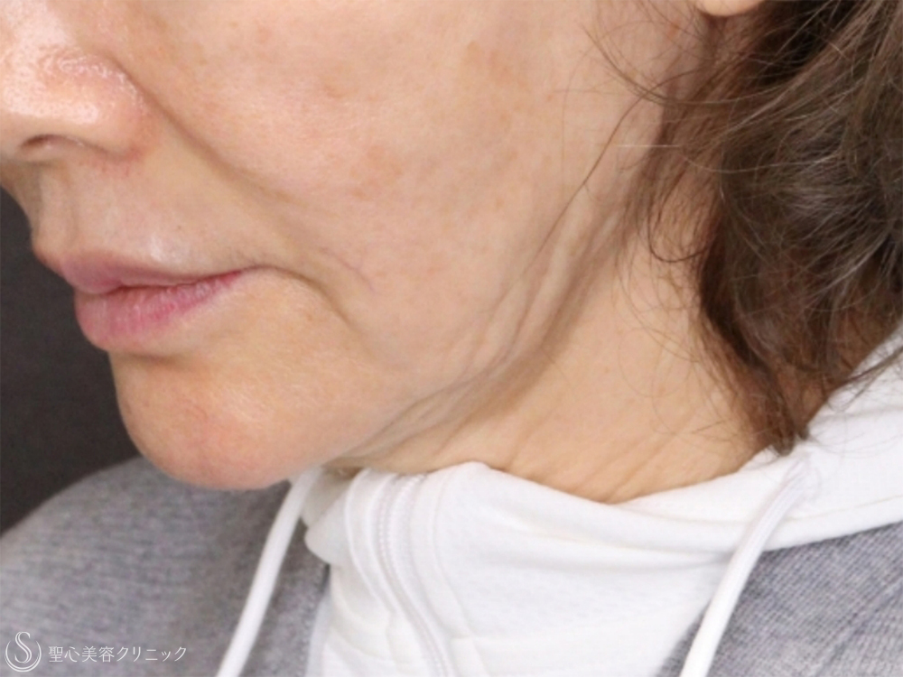 【70代女性・機械の引き締めでも難しいたるみにも有効】PDRNモノスレッド（3ヶ月後） After 