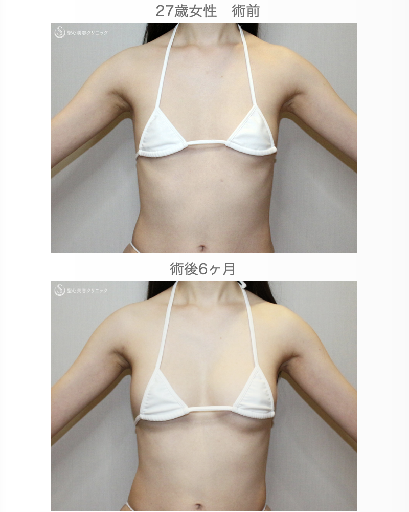 【27歳女性・脂肪幹細胞豊胸】プレミアムセリューション豊胸術（術後2日目〜6ヶ月後） After 